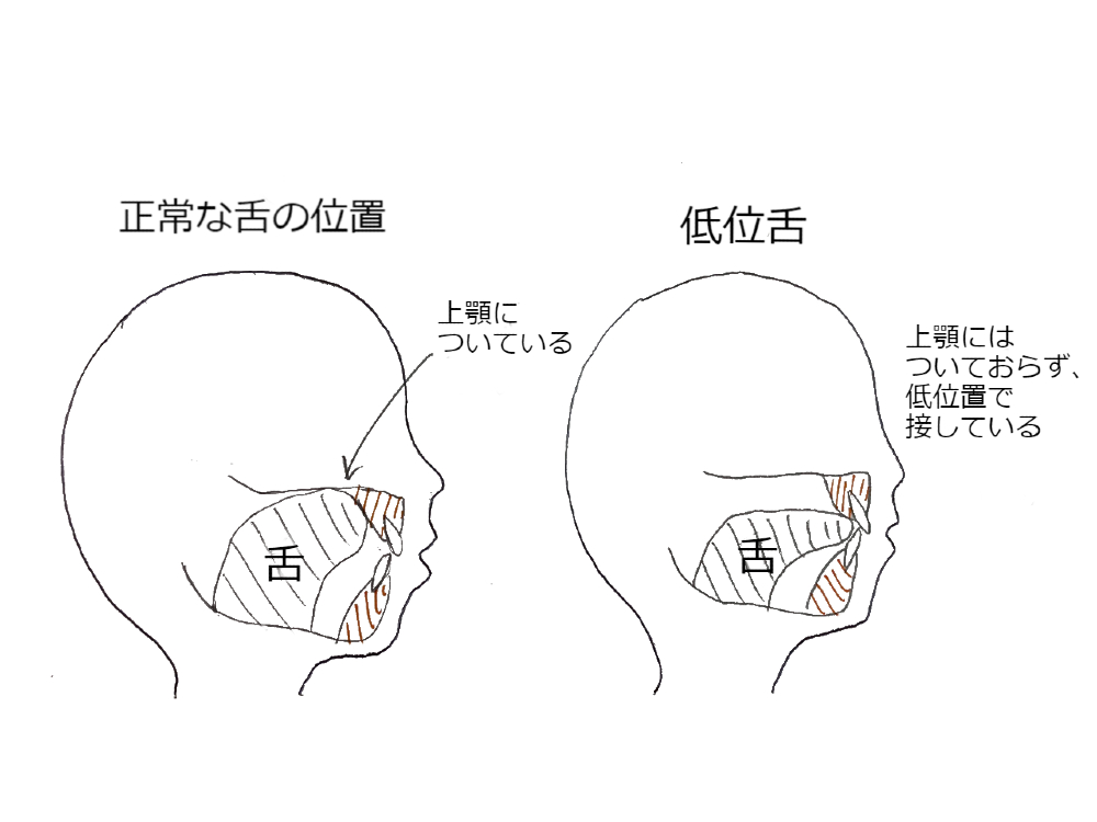 食事でクチャクチャ音 舌の位置が低い 低位舌 の原因 弊害 治療法 オトナンサー