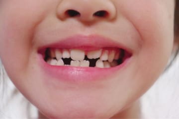 歯の生え変わり、なぜ1回だけ？