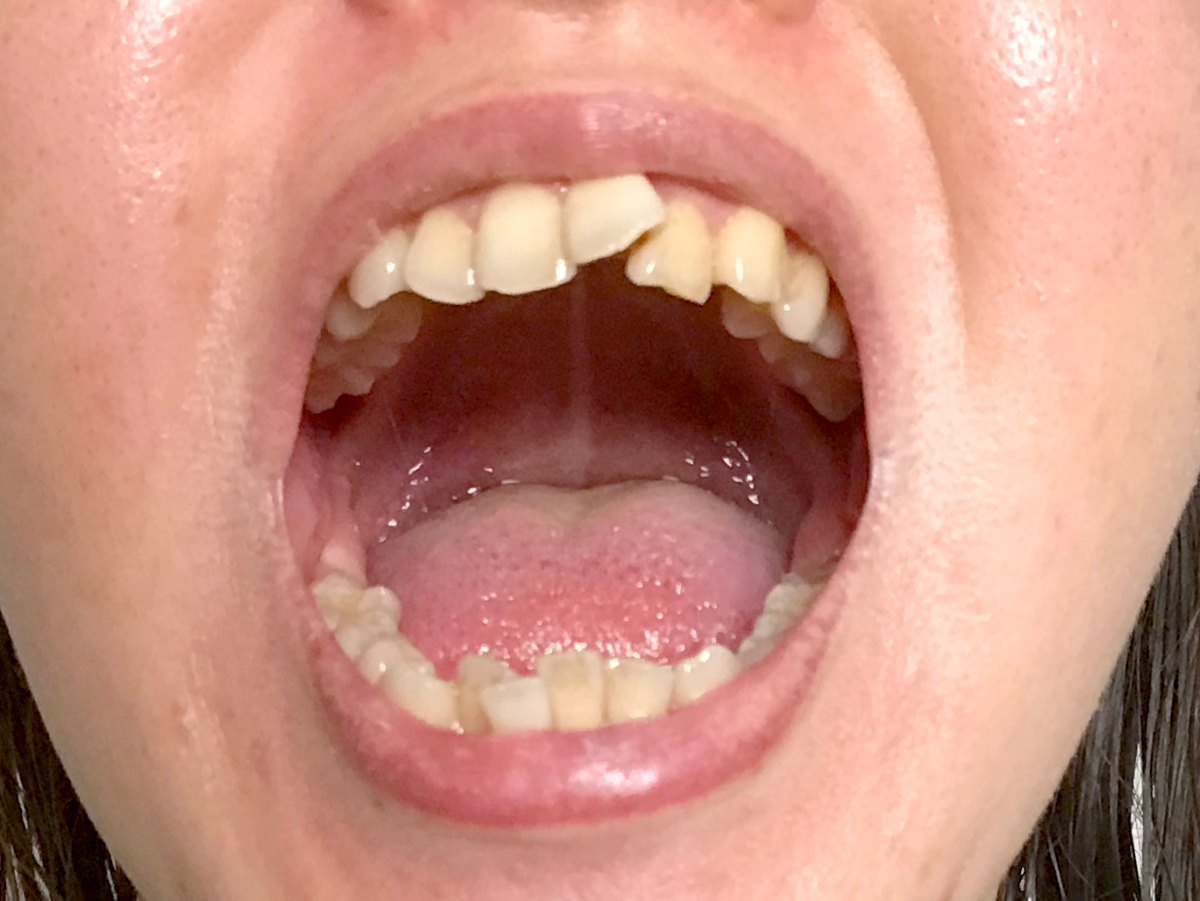 悪い歯並びの一例。歯列矯正治療を行うことで、歯磨きがしやすくなることも
