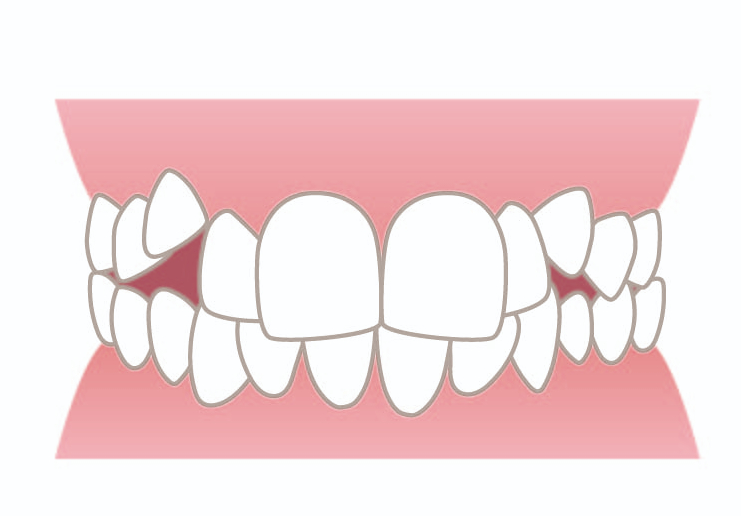 悪い歯並びは遺伝する？