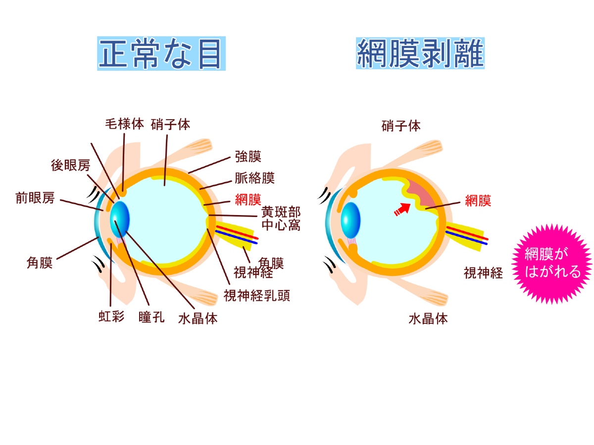 網膜剥離の目と正常な状態の目