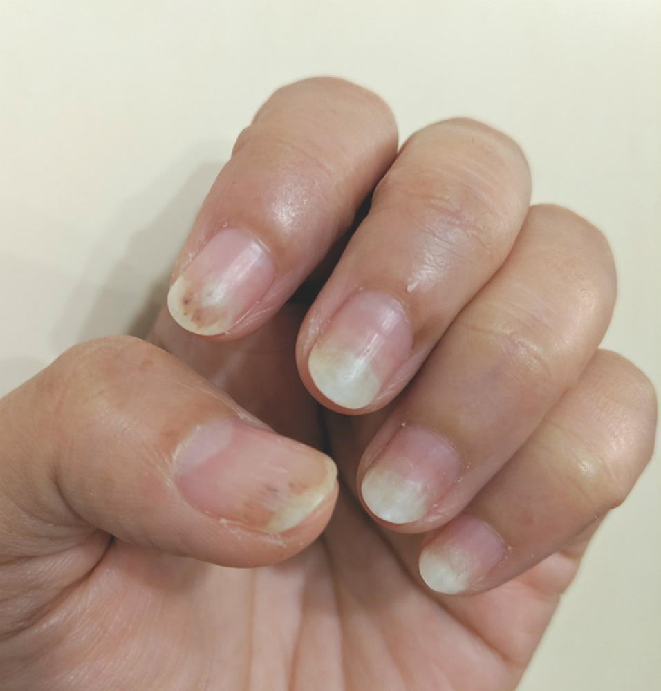 爪甲剥離症(そうこうはくりしょう)と見られる女性の爪