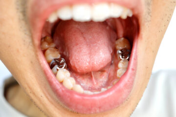 銀歯は外れる前に交換すべき？